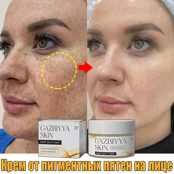 Gazbiyya skin krem ​​-krem -ylepbelivanya yudalenipe -yvesnuшek/ dly -yudalenip 